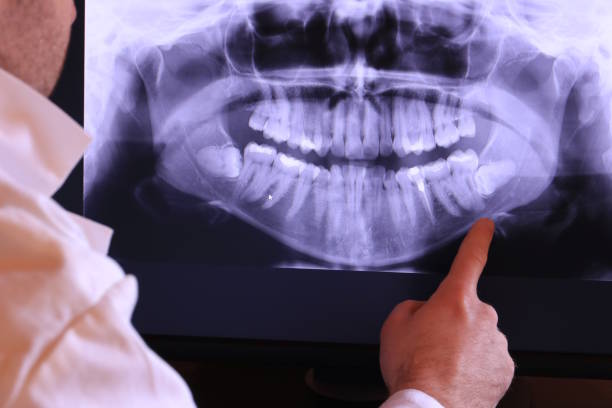 Best Emergency Dental Care for Abscessed Tooth in Olean, NY