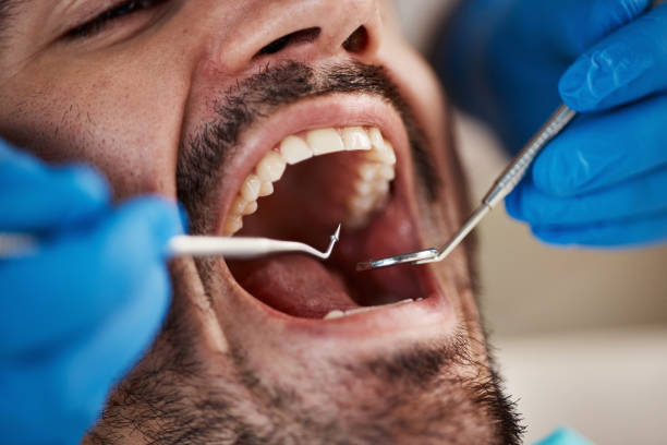 Best Emergency Dentist for Lost Fillings or Crowns in Olean, NY