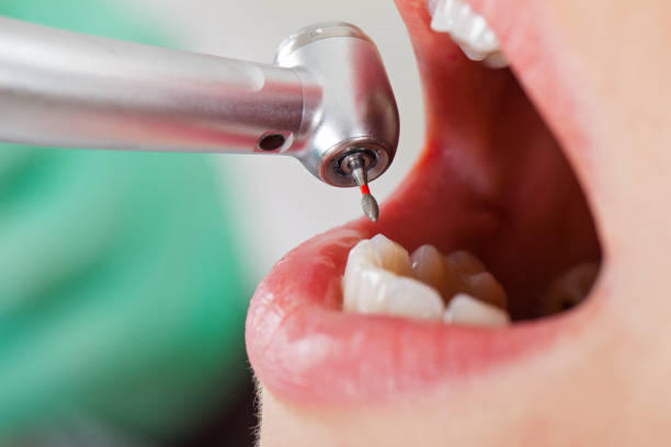 Best Emergency Root Canal Treatment in Olean, NY